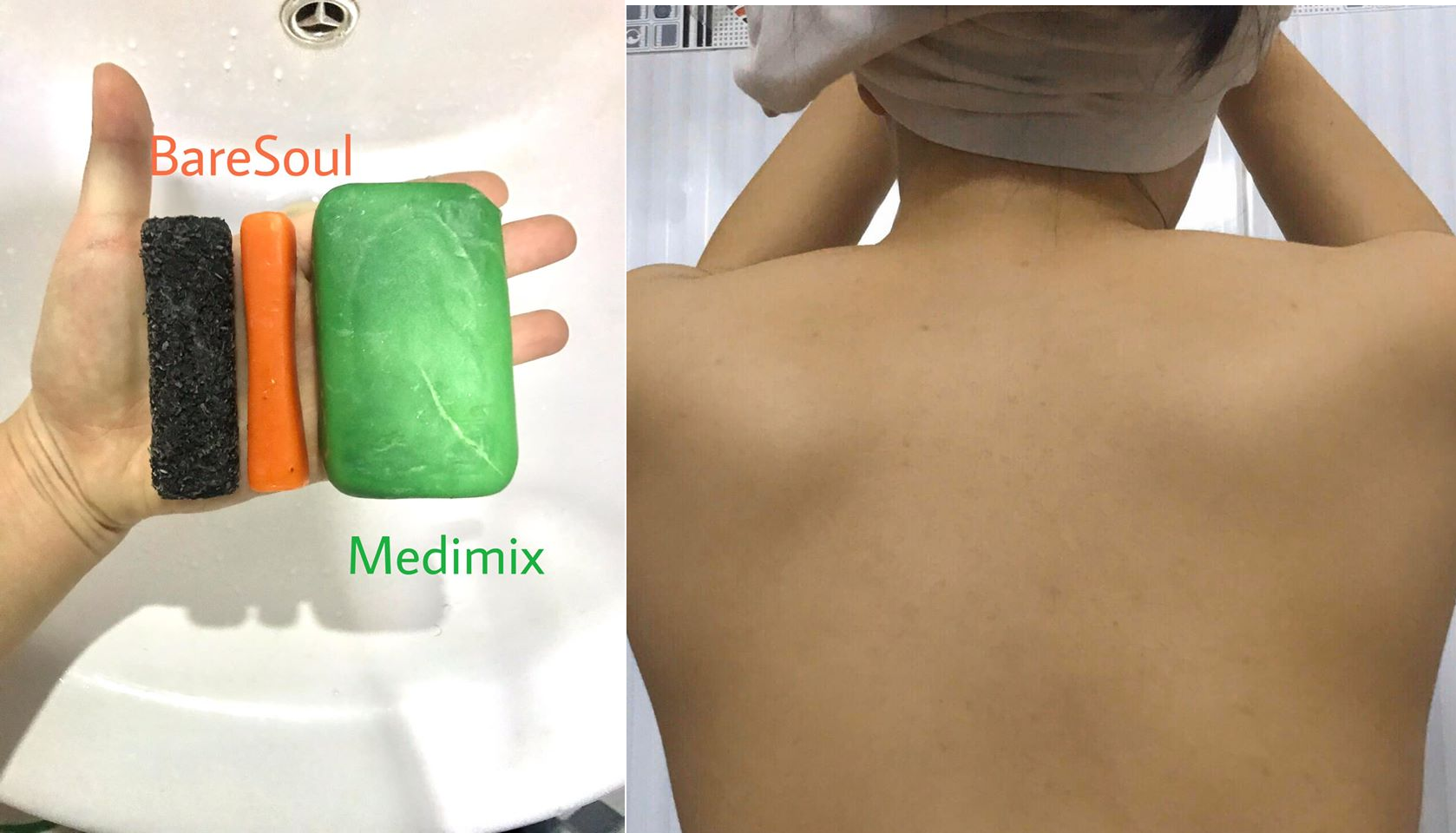 review sản phẩm trị mụn lưng